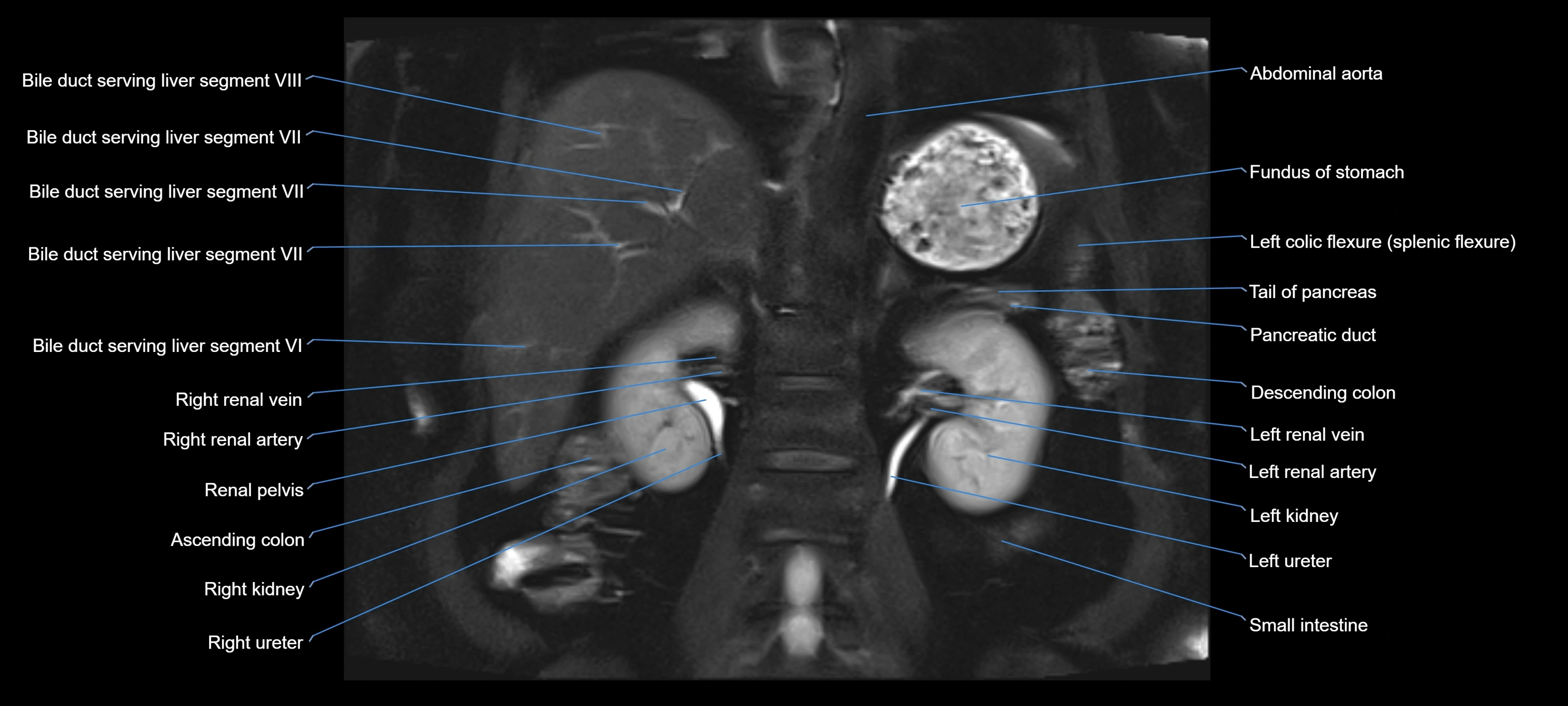 MRI MRCP coronal cross sectional 3T radiology  image-img-00001-00018.webp